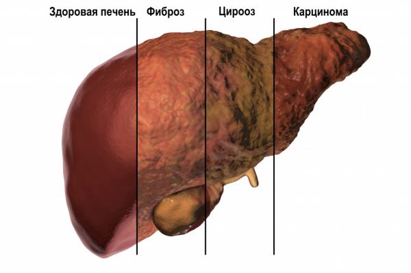 Hepatit C nədir? Əlamətləri və necə müalicə olunur?...